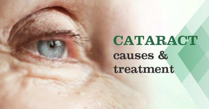 Cataracts: Causes and Treatment